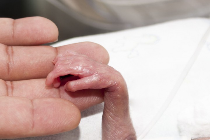 Здравословното състояние на момиченцето родено преждевременно през 28 та седмица